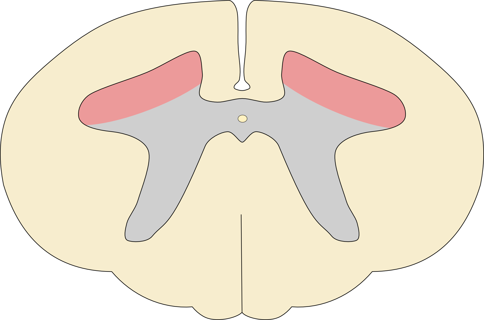 Anterior horn cell syndrome