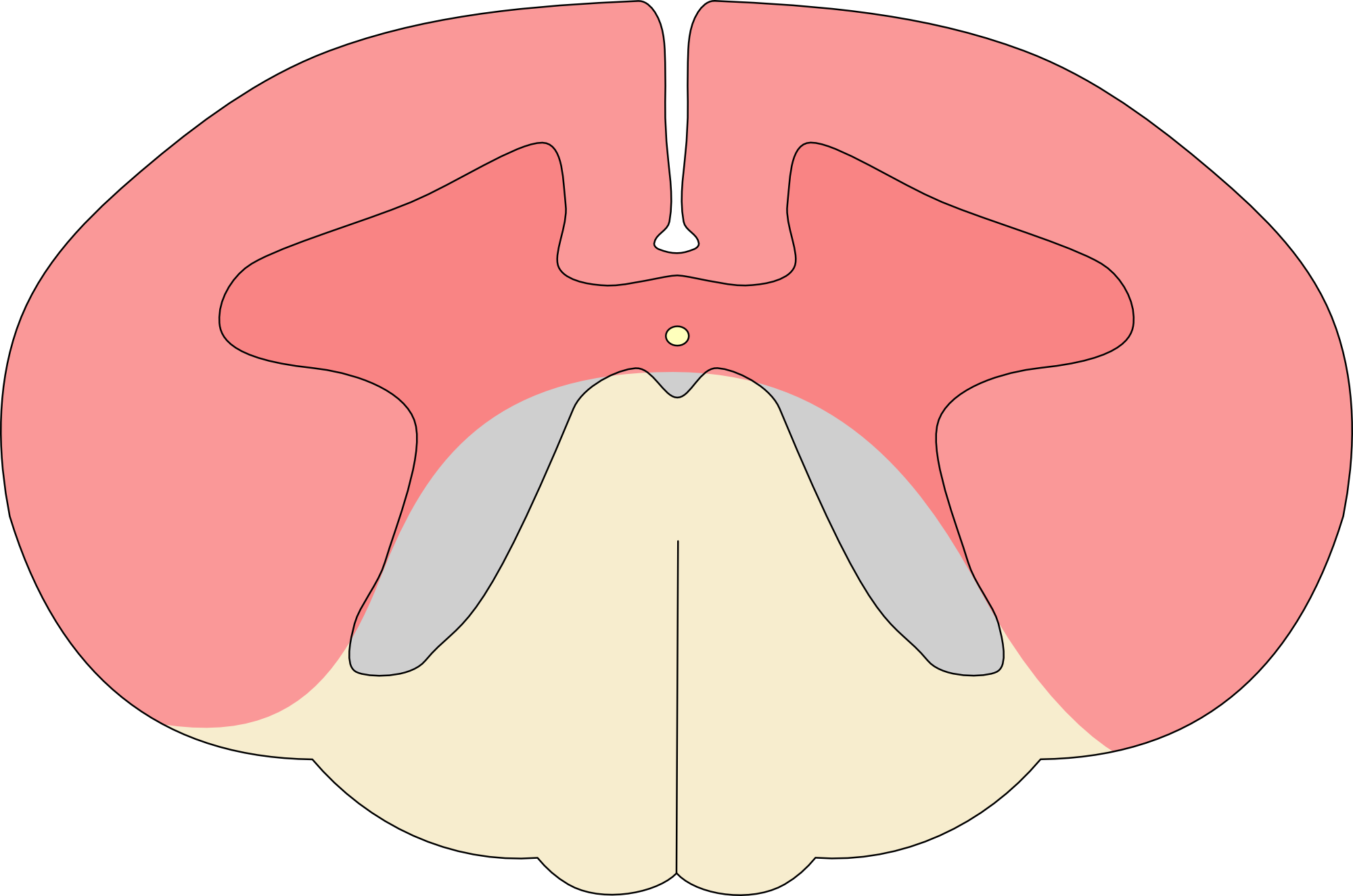 Anterior spinal cord syndrome