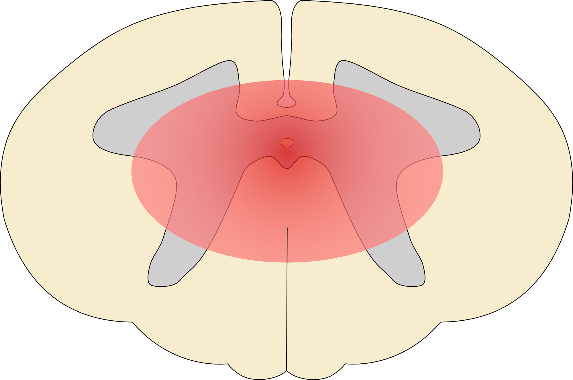Central spinal cord syndrome