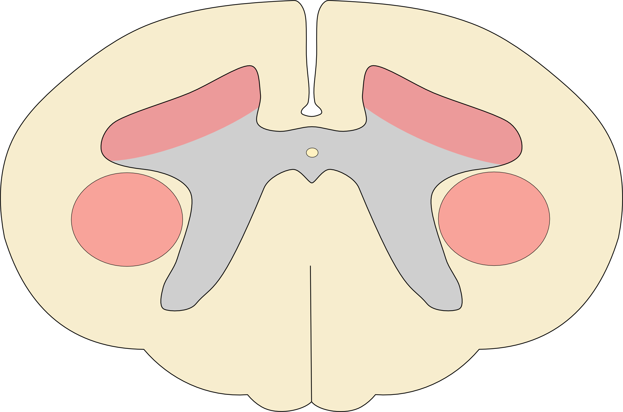 Combined anterior horn cell and pyramidal tract syndrome