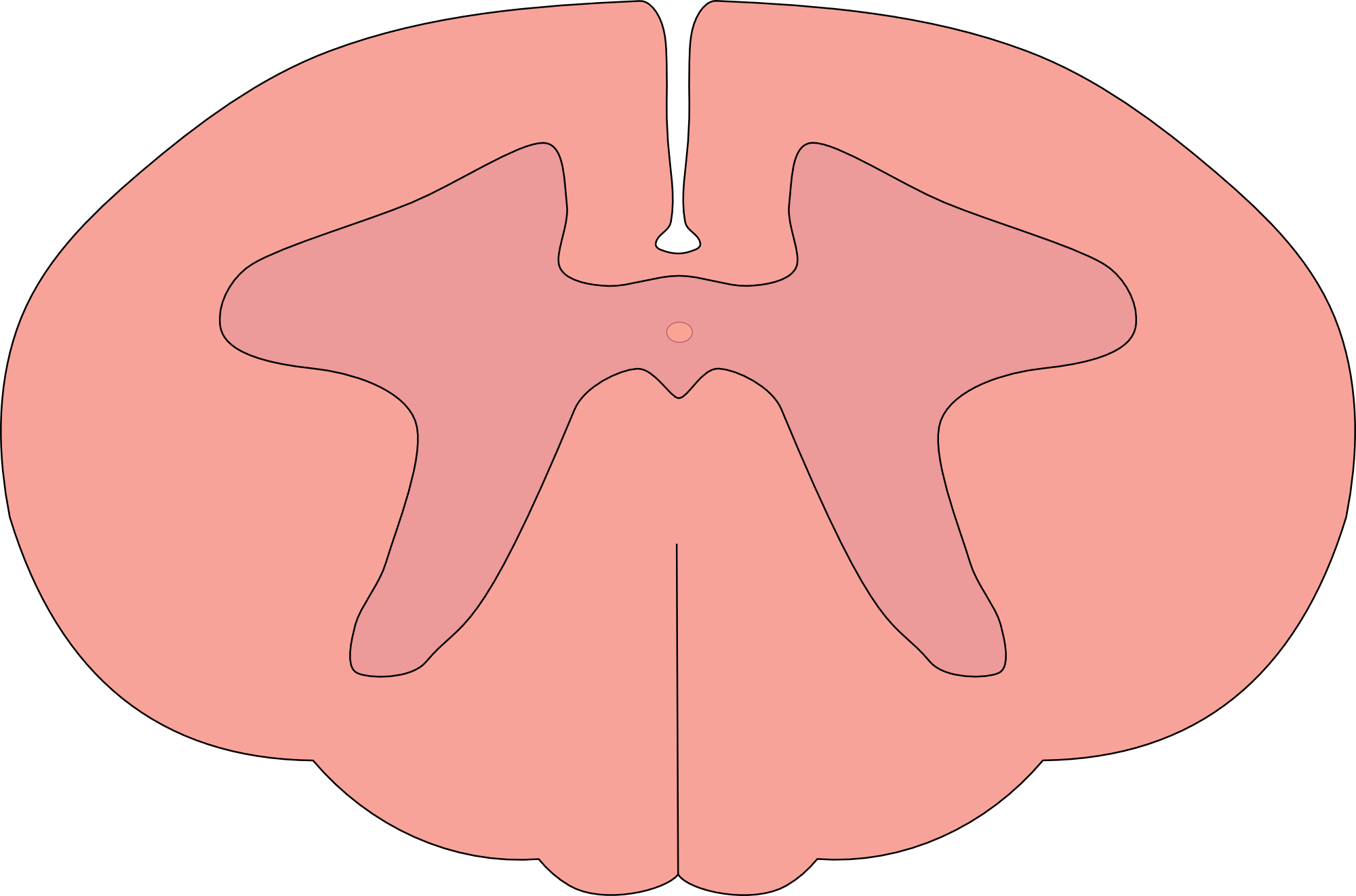 Anterior horn cell syndrome