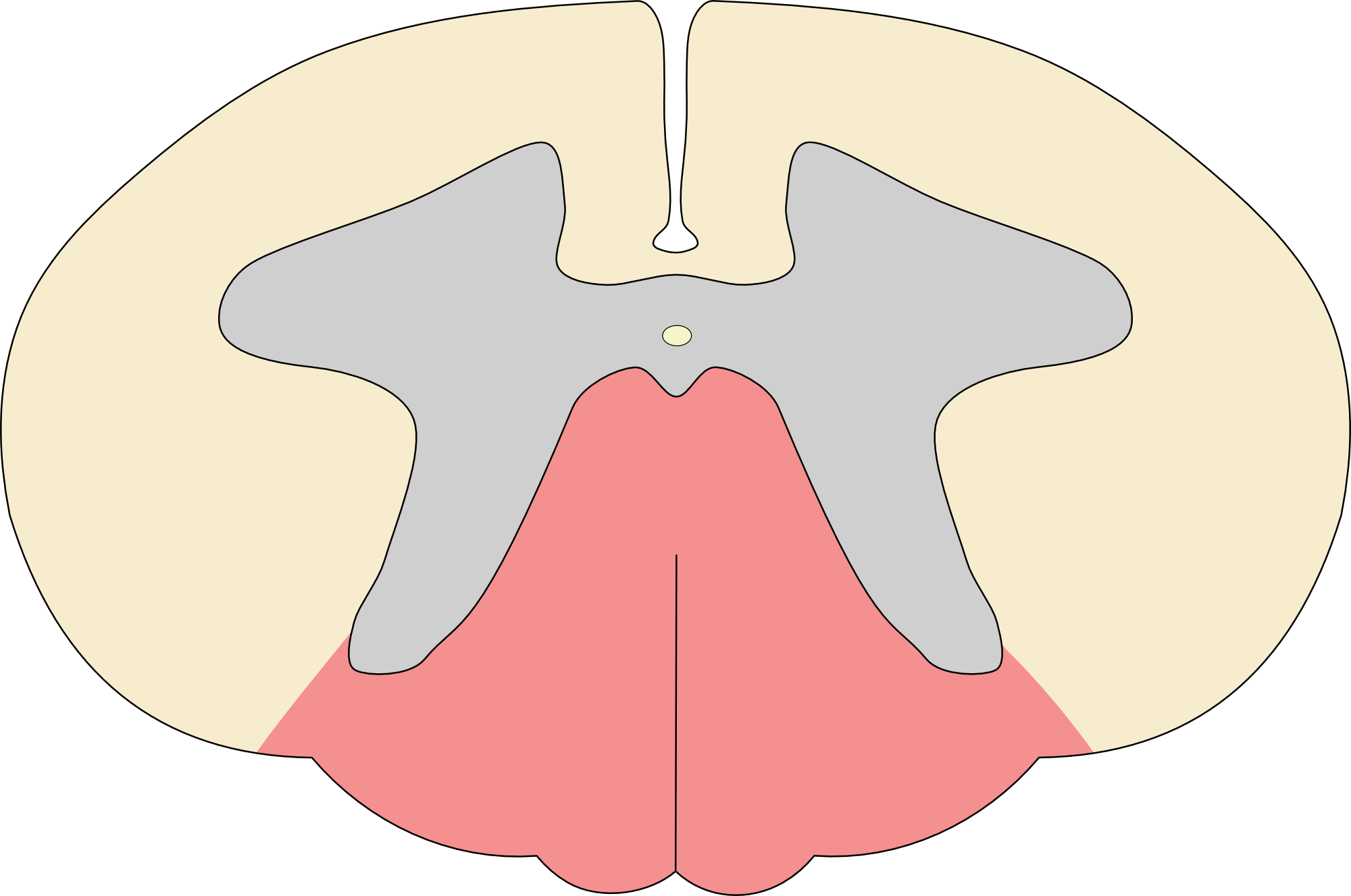 Posterior column syndrome