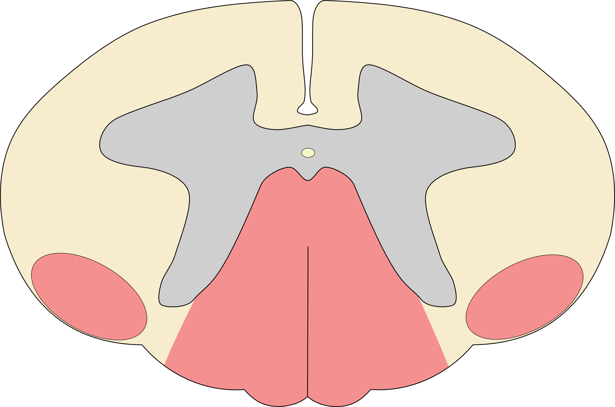 Posterolateral column syndrome