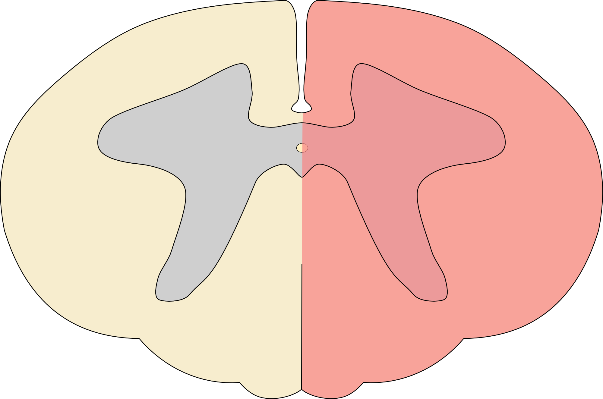 Spinal cord hemisection