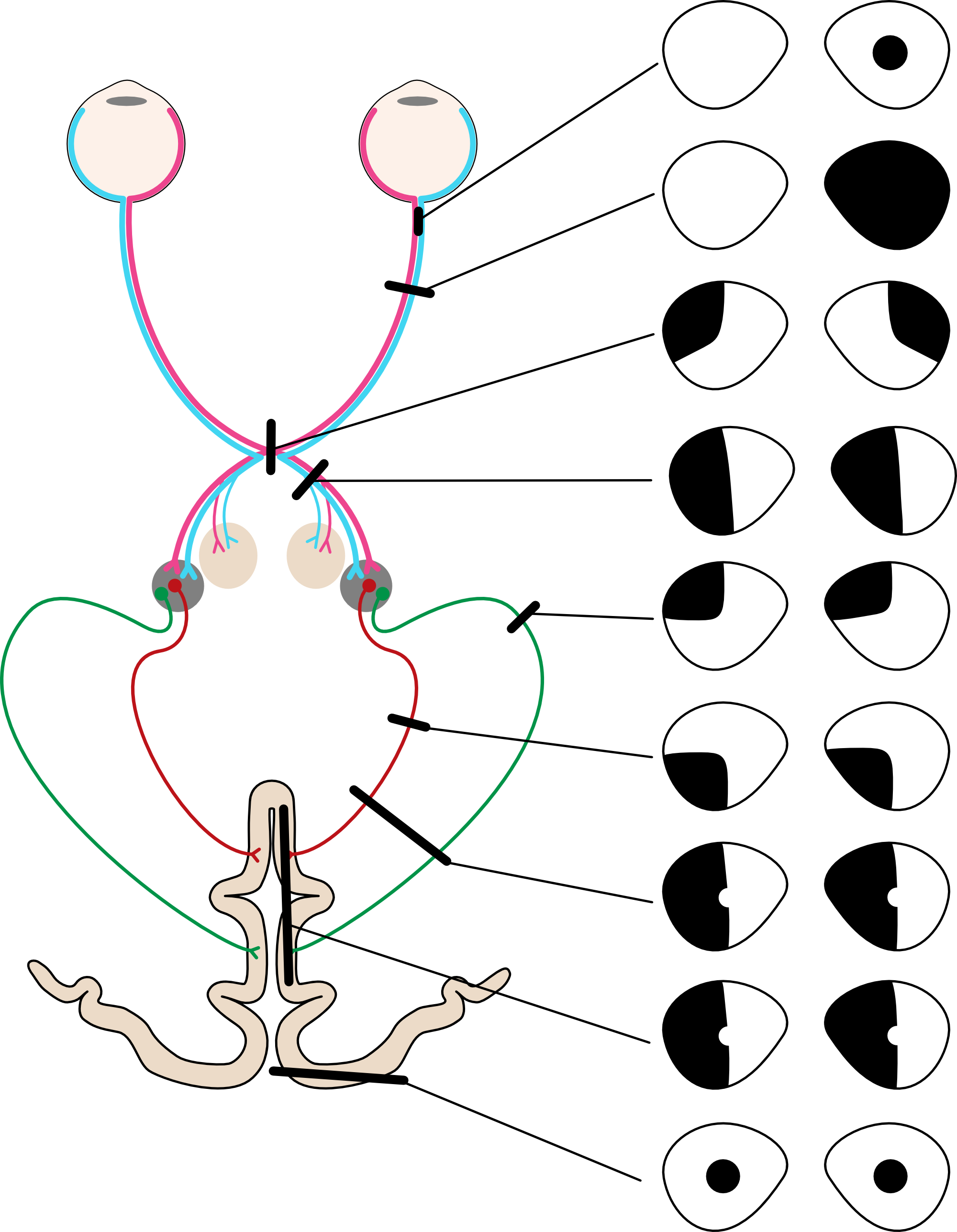 Visual system lesions